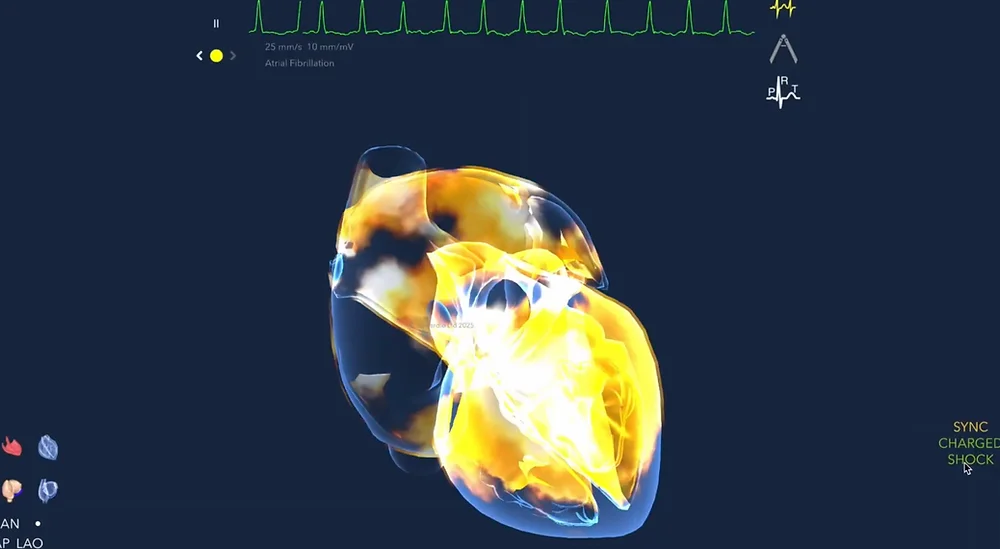 Repeated Cardioversions Or Catheter Ablation Which Is The Better Treatment For Atrial Fibrillation