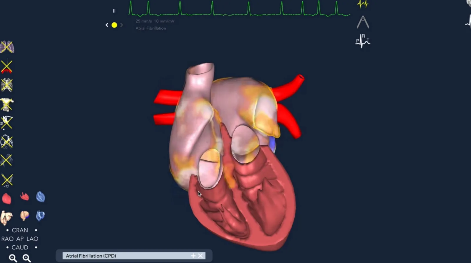 3D heart model used to explain atrial fibrillation returning after ablation