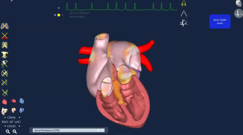 3D model of the heart with an ECG trace showing atrial fibrillation