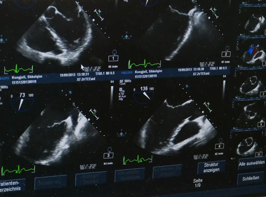 Echocardiogram images of the heart on a monitor